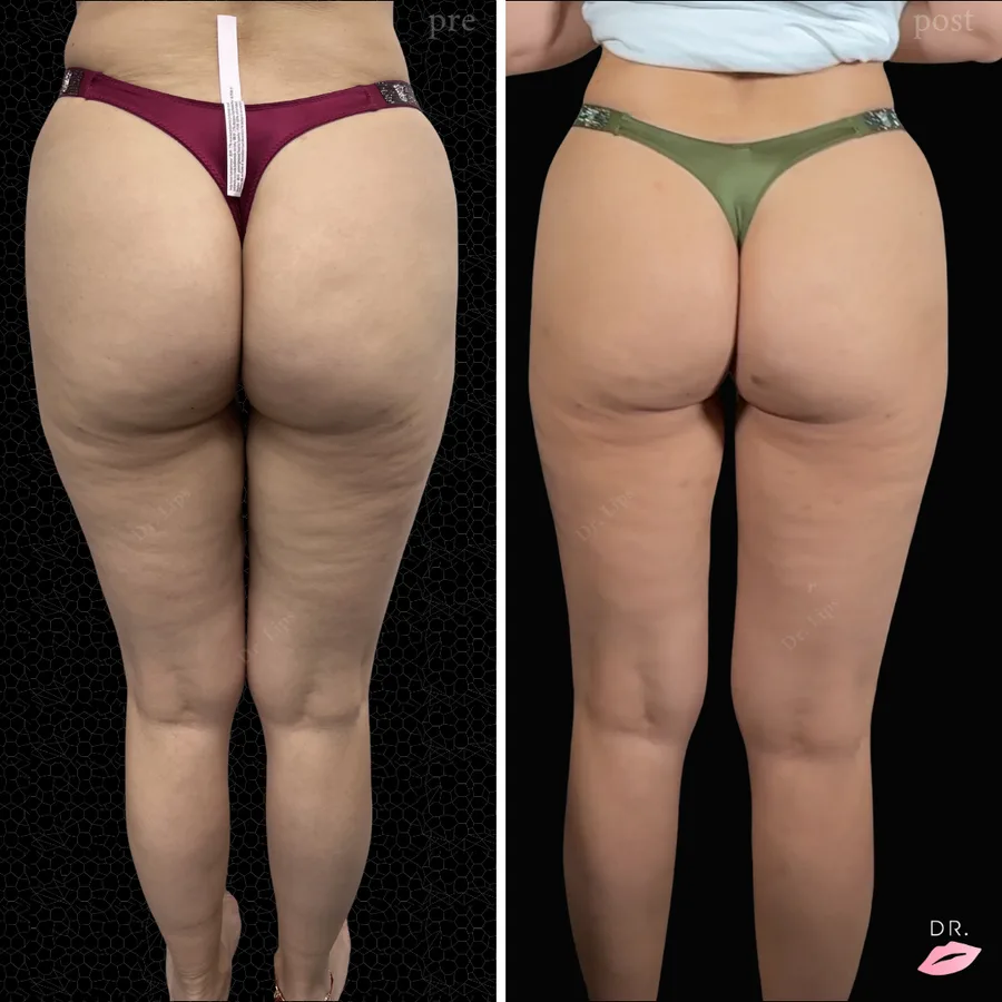 Carbossiterapia prima e dopo - biostimolazione cutanea caso 4 - Dr. Lips