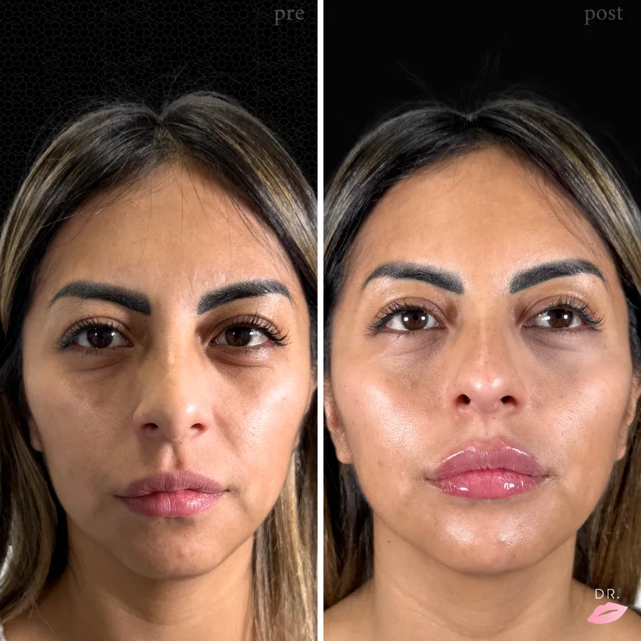 Face contouring prima e dopo - definizione ovale del viso caso 1 - Dr. Lips Milano