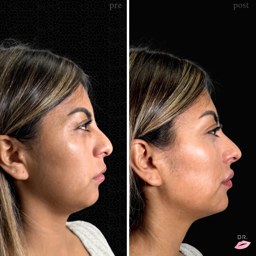 Face contouring prima e dopo - rimodellamento zigomi caso 2 - Dr. Lips