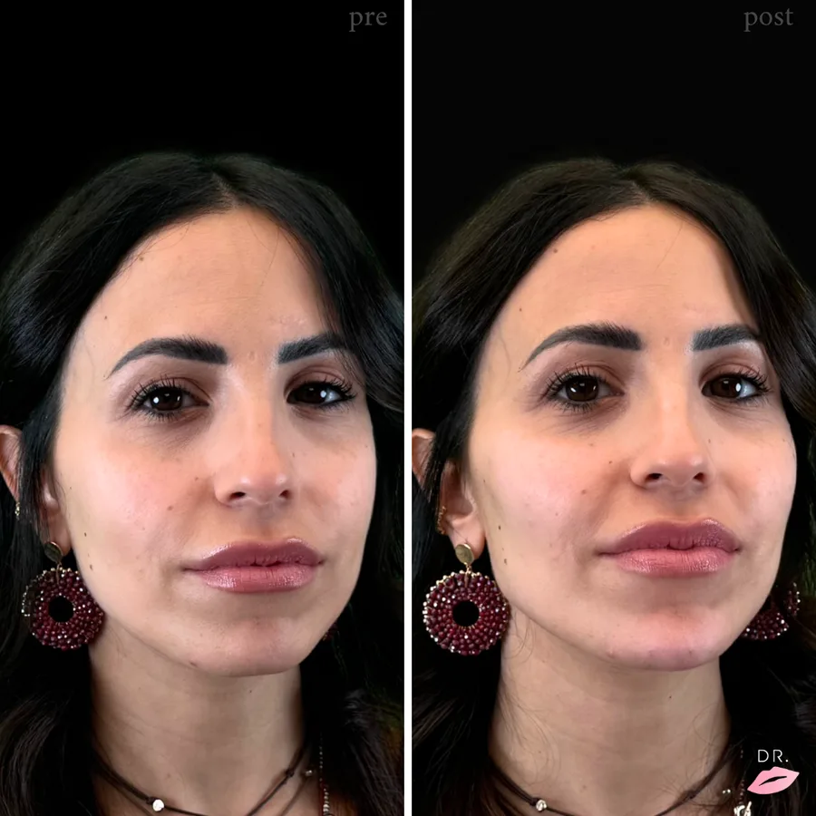 Face contouring prima e dopo - filler zigomi e mandibola caso 3 - Dr. Lips