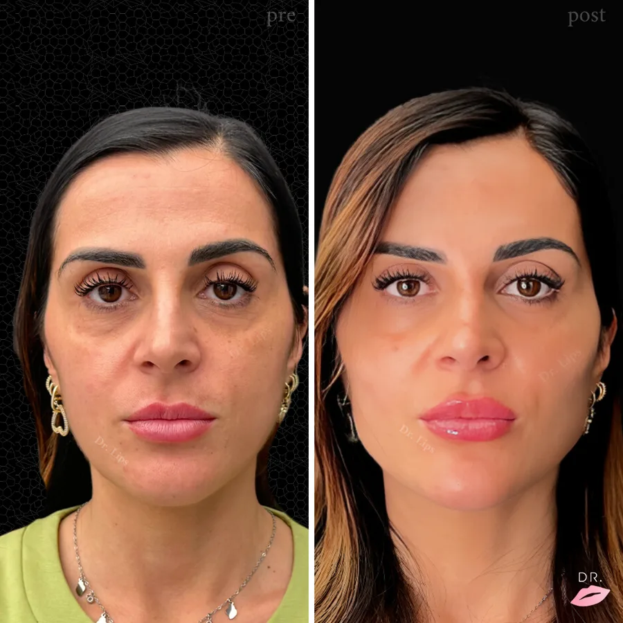 Face contouring prima e dopo - risultato naturale caso 4 - Dr. Lips