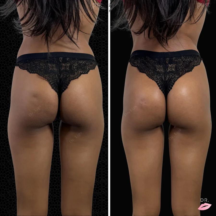 Filler glutei prima e dopo - volumizzazione glutei con acido ialuronico caso 1 - Dr. Lips