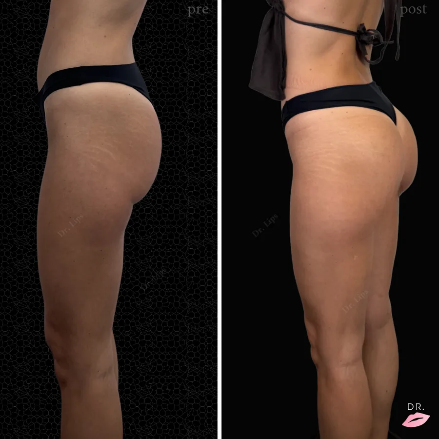 Filler glutei prima e dopo - risultato trattamento glutei caso 2 - Dr. Lips