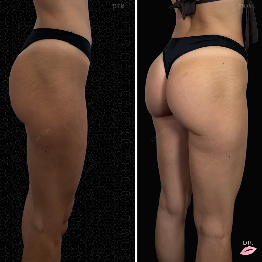 Filler glutei prima e dopo - modellamento glutei non chirurgico caso 3 - Dr. Lips