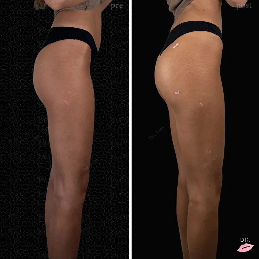 Filler glutei prima e dopo - volumizzazione naturale glutei caso 5 - Dr. Lips