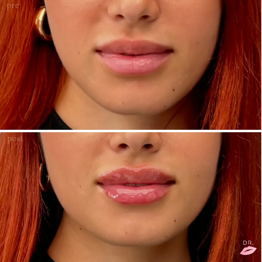 Filler labbra prima e dopo - risultato naturale caso 1 - Dr. Lips Milano