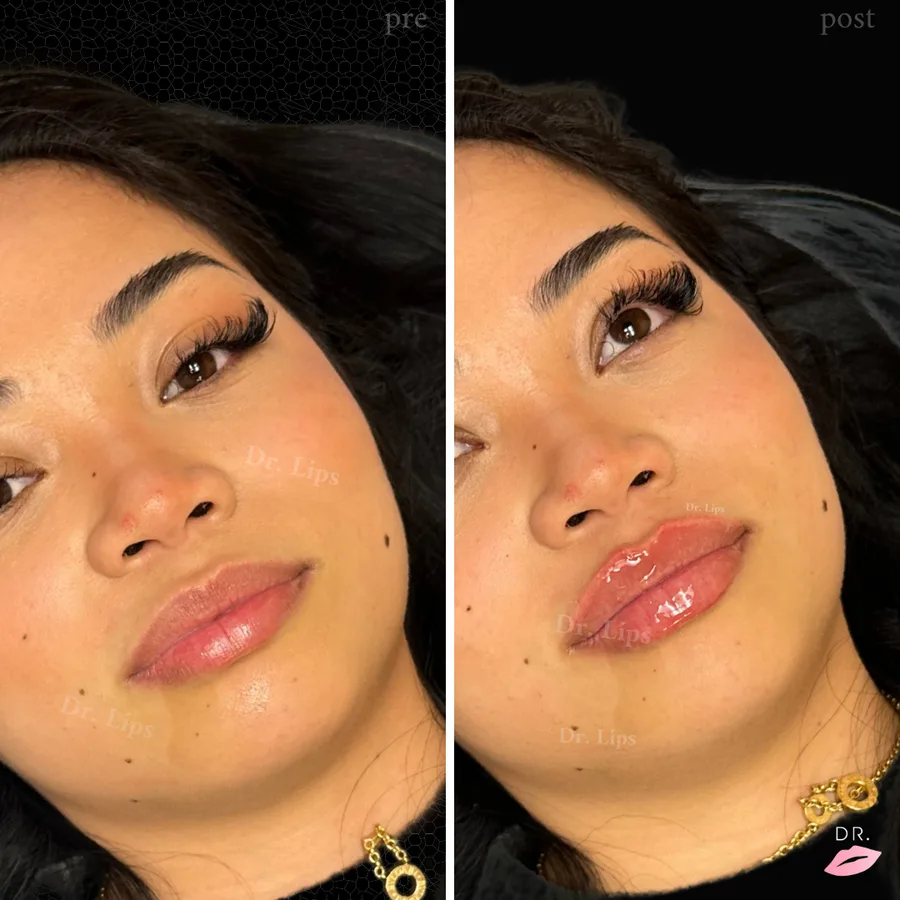 Filler labbra prima e dopo - labbra naturali caso 3 - Dr. Lips