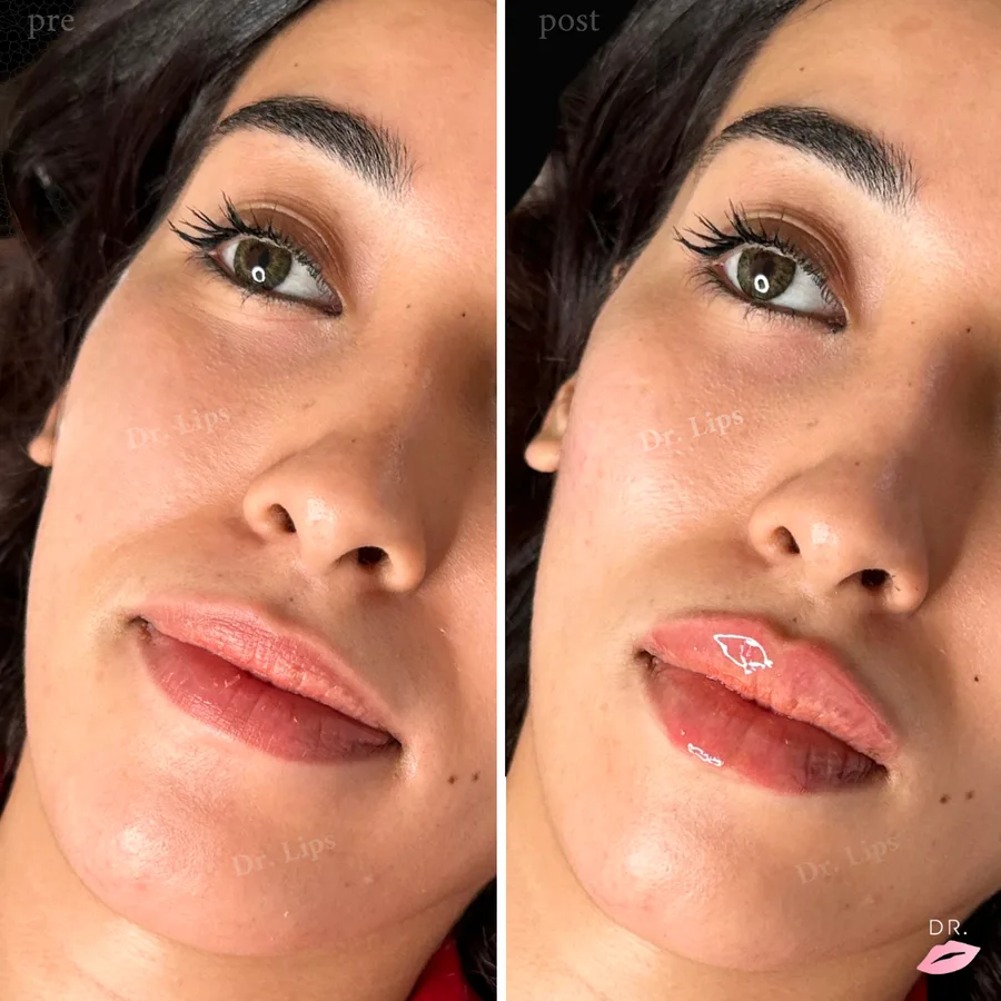 Filler labbra prima e dopo - risultato volumizzazione caso 4 - Dr. Lips