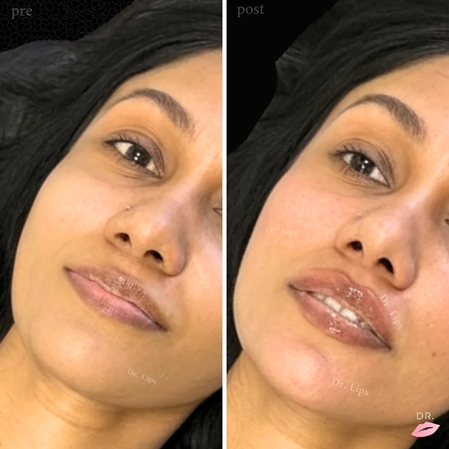 Filler labbra prima e dopo - scultura labbra caso 5 - Dr. Lips Milano