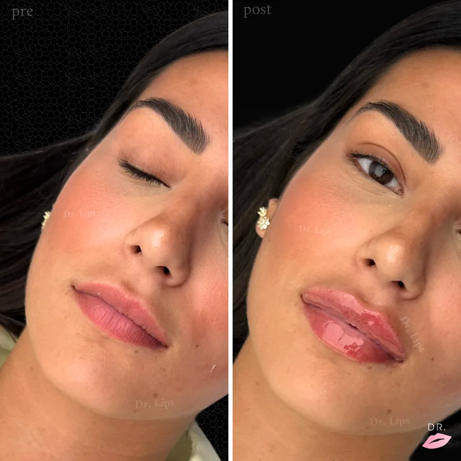 Filler labbra prima e dopo - labbra armoniche caso 6 - Dr. Lips