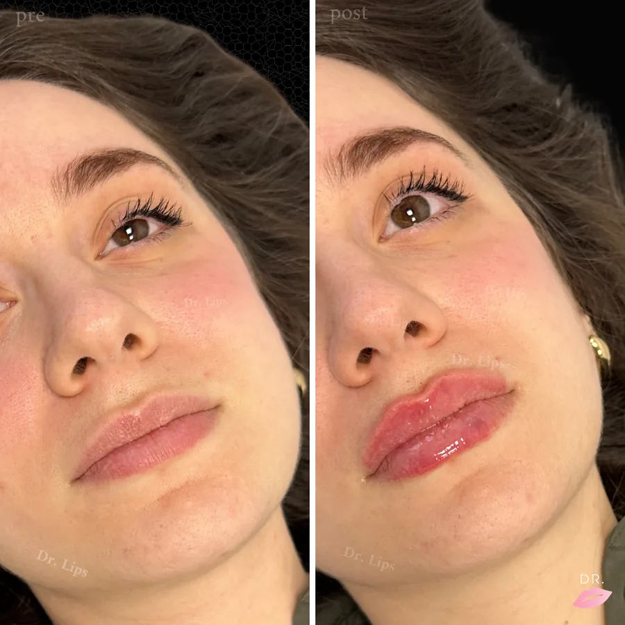Filler labbra prima e dopo - risultato estetico caso 8 - Dr. Lips