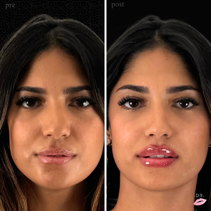 Filler labbra prima e dopo - volumizzazione naturale caso 9 - Dr. Lips