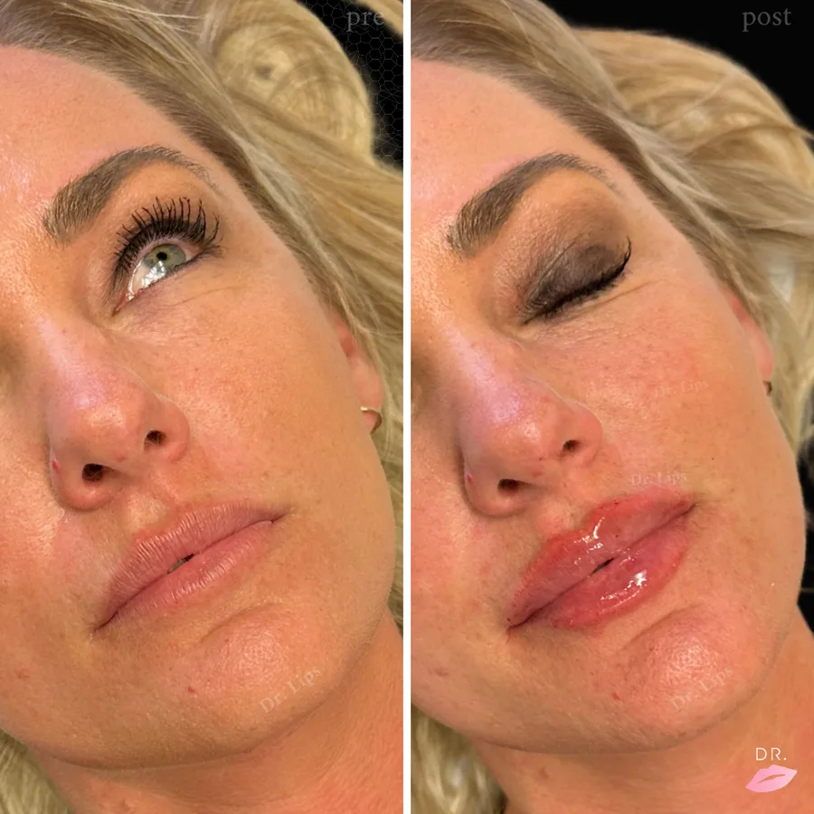 Filler labbra prima e dopo - labbra case 10 - Dr. Lips Milano