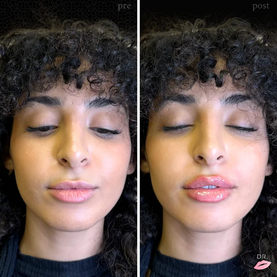 Filler labbra prima e dopo - trattamento estetico caso 11 - Dr. Lips