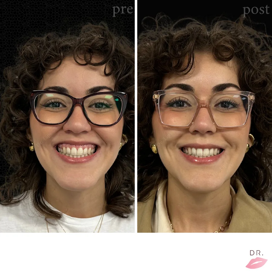 Gummy smile prima e dopo - trattamento botulino sorriso caso 2 - Dr. Lips