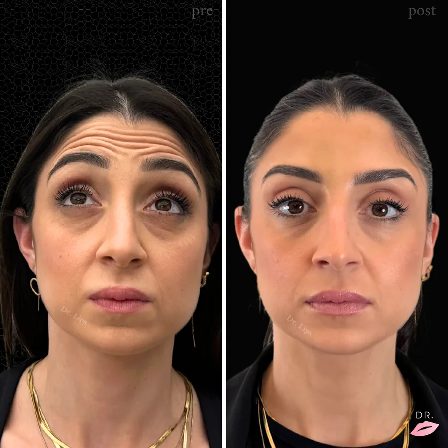 Botulino rughe fronte prima e dopo - risultato naturale caso 3 - Dr. Lips