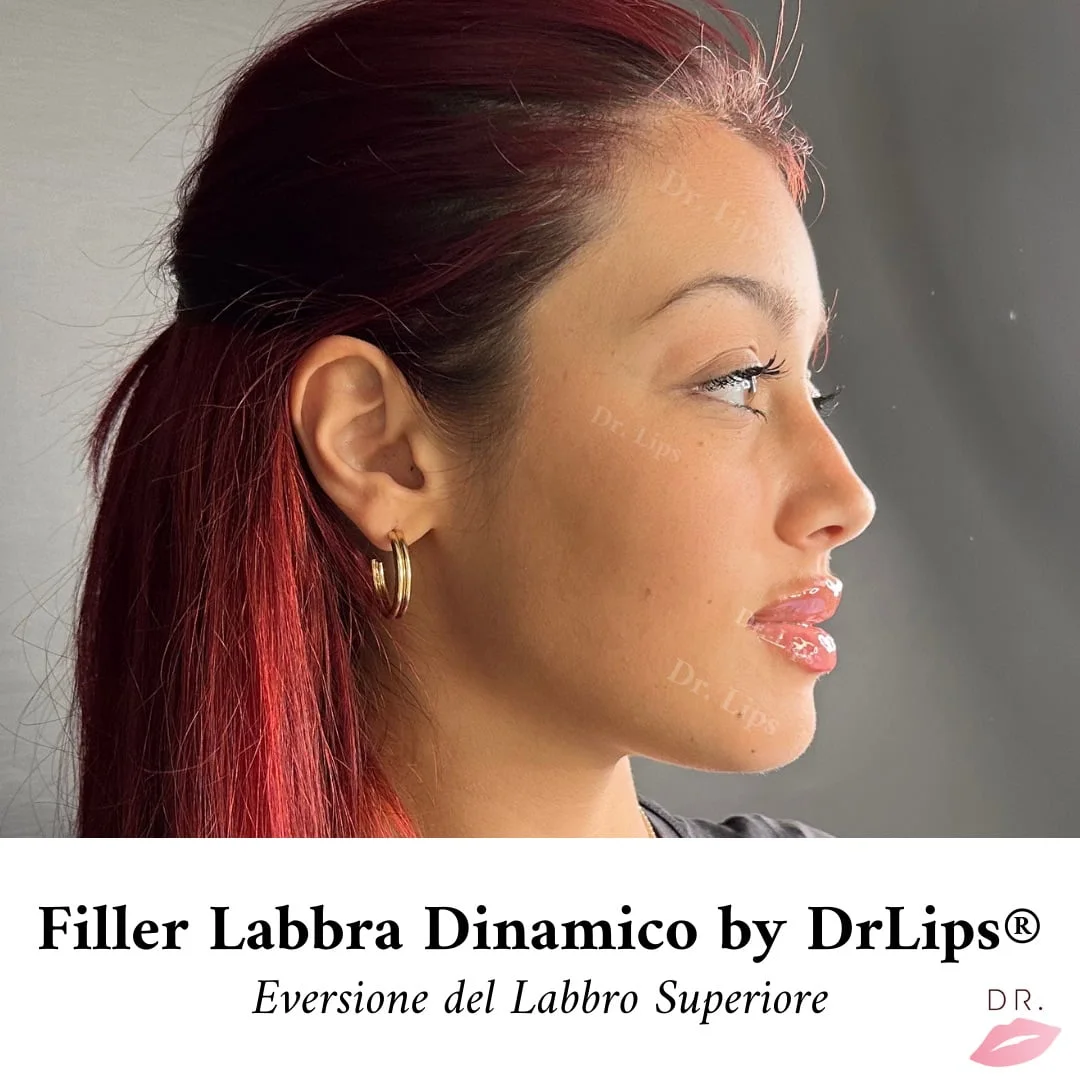 Tecnica iLips filler labbra Dr Lips risultato naturale