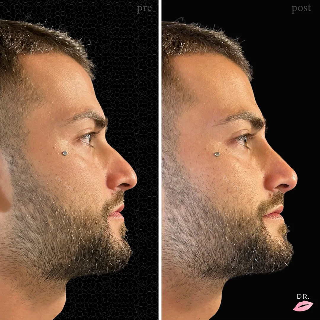 Masterclass Corso Rinofiller — Dr Lips