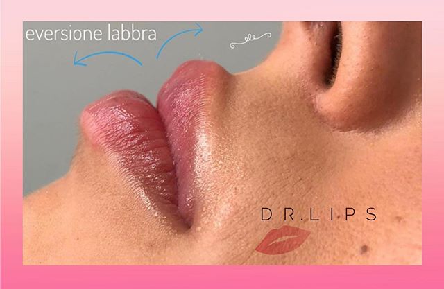 dr lips - eversione labbra